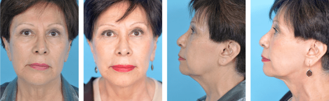facelift before and after from Chicago Plastic Surgery LLC